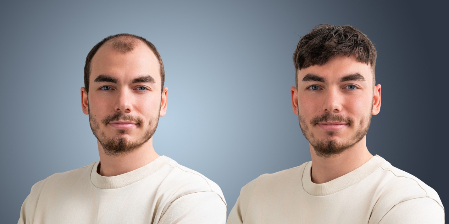 Junger Mann mit und ohne Haarsystem im Vergleich