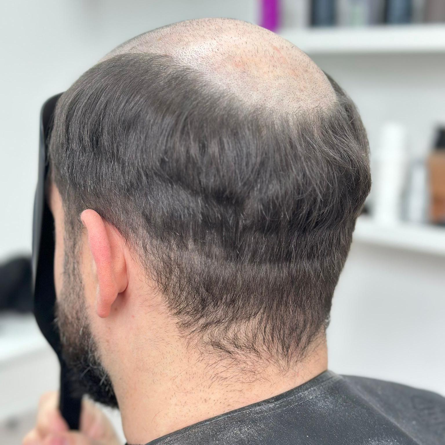 Kunde ohne Haarsystem, sichtbarer Haarausfall