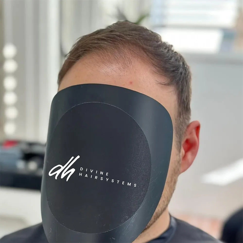 Mann mit lichtem Haar vor dem Einsatz eines Haarsystems