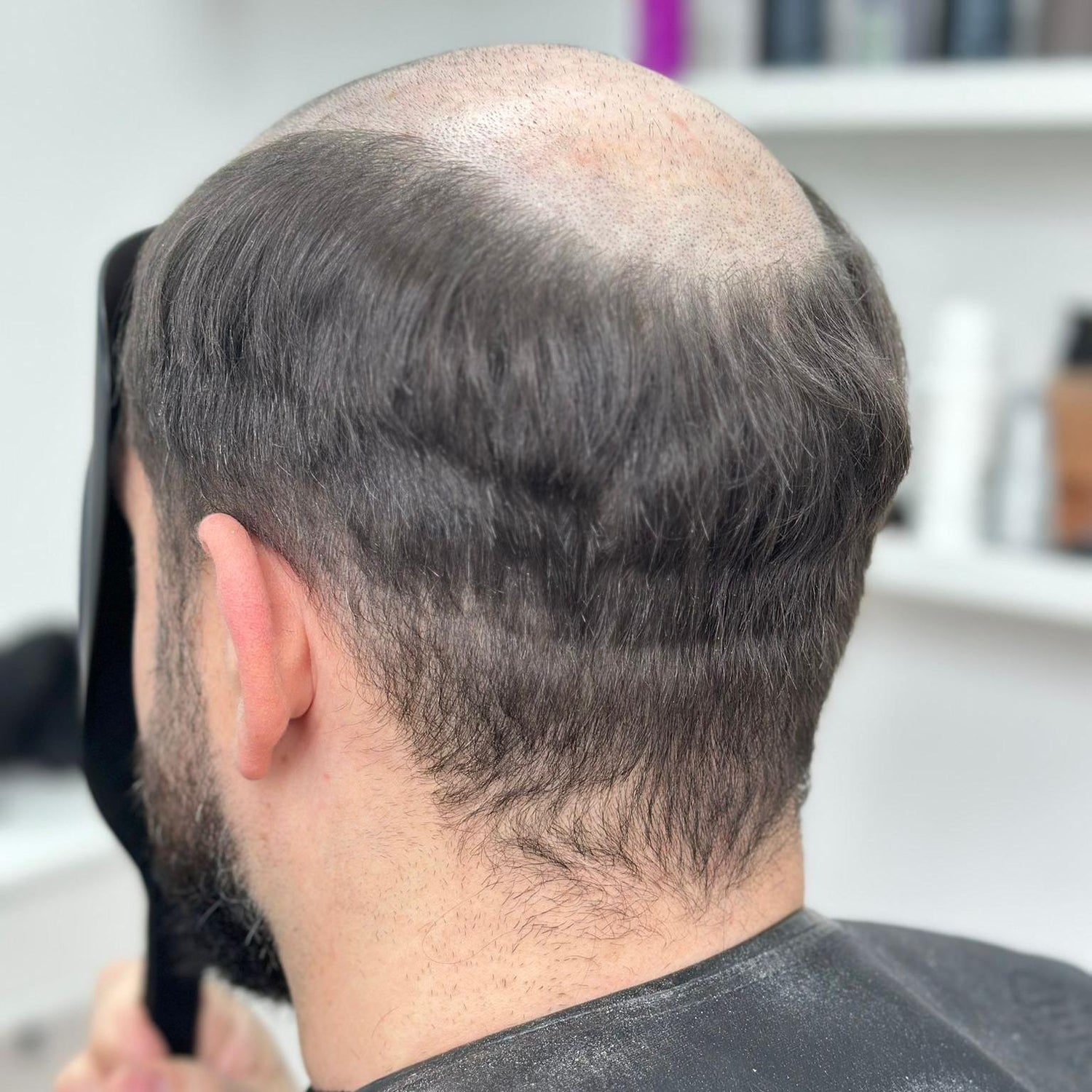 Kunde ohne Haarsystem, sichtbarer Haarausfall